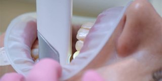 牙科诊所正畸医生用口腔内扫描仪扫描病人的牙齿。