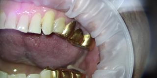 牙医。在显微镜下拍摄的视频。用钩子取下上颚的金桥