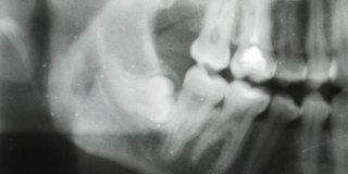 相机沿牙科全景x光移动。水平追踪上下颌牙齿。CAT扫描的特写