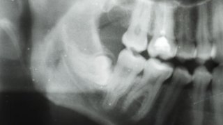 相机沿牙科全景x光移动。水平追踪上下颌牙齿。CAT扫描的特写视频素材模板下载
