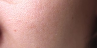 女性皮肤过敏问题紧锁。面部干燥，毛孔鳞状，发红。