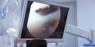手术过程在手术室的屏幕上。医疗监视器显示使用医疗工具进行显微手术。特写镜头。