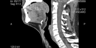 人颈部矢状面CT扫描