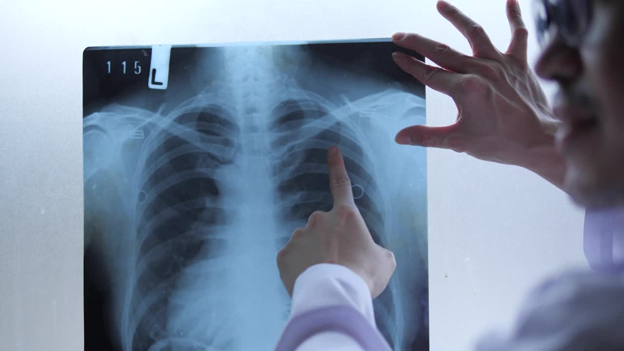在医院里，医生会检查Covid-19患者的x光片是否为肺炎。冠状病毒的假设