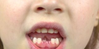 这是一个小女孩的特写，她的嘴露出了脱落的乳牙，做着鬼脸。