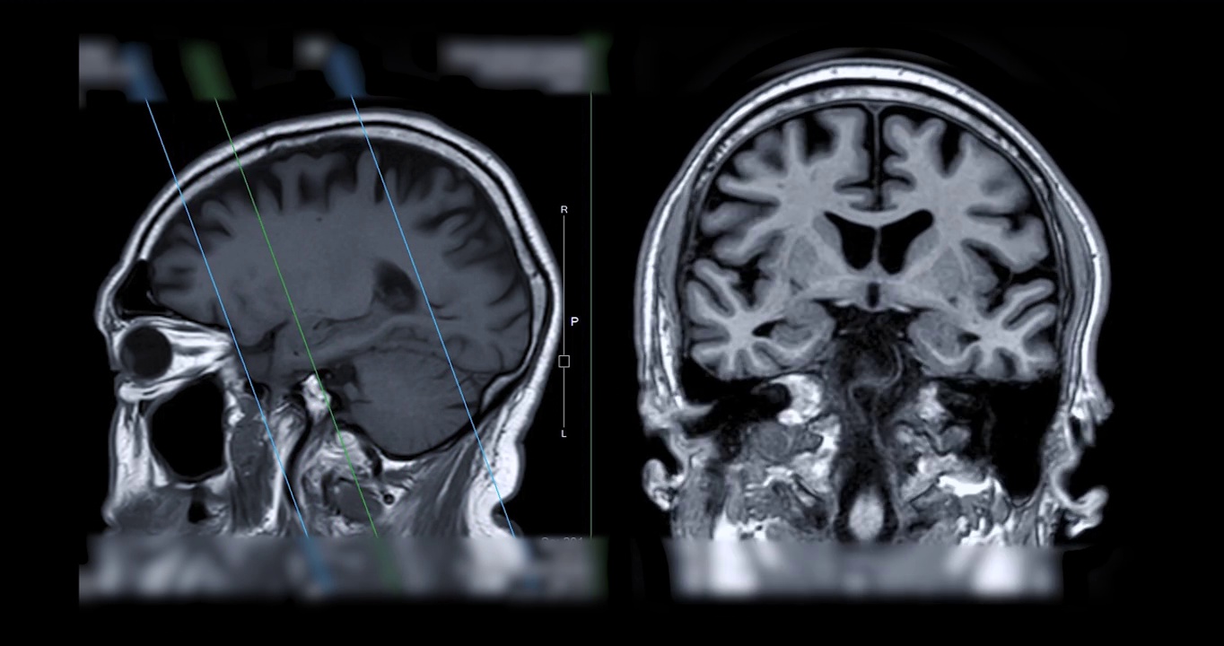 脑MRI比较矢状面和冠状面对痴呆患者海马的诊断作用。