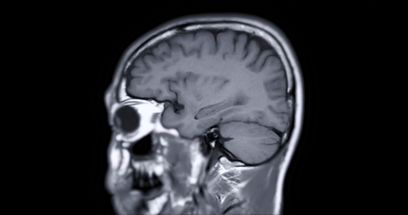 MRI为脑矢状位T1W平面，脑磁共振成像。