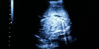 人体胚胎的医学超声扫描。在电脑显示器上，你可以看到24周的宝宝——8号腿