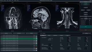 医学软件界面实时显示大脑磁共振图像扫描过程。真实的MRI有助于诊断神经系统疾病，肿瘤，损伤，中风，感染，头痛视频素材模板下载