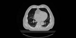 一个肺部肿瘤病人的CT扫描