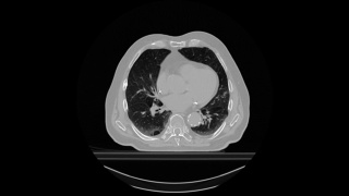 一个肺部肿瘤病人的CT扫描视频素材模板下载