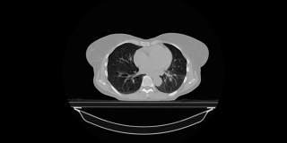 一名女性肺癌患者的CT扫描