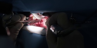 手术在深度麻醉下切除扁桃体，关闭喉咙，外科医生使用最新的设备，冷等离子法，切开喉咙肿胀，医生用新的探针工作