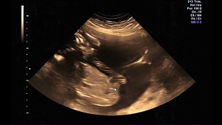 婴儿或胎儿在21周时踢的超声波视频素材模板下载