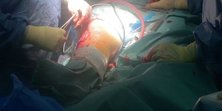 手术室膝盖外科医生闭合伤口