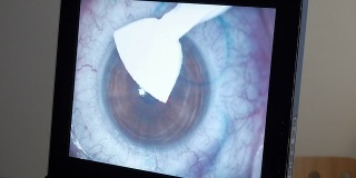 MACRO:激光眼科手术，第5步