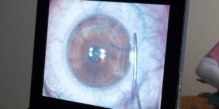 MACRO:激光眼科手术，第6步