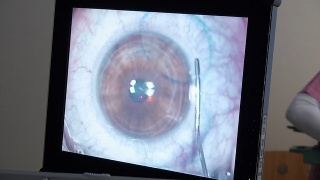 MACRO:激光眼科手术，第6步视频素材模板下载