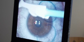 MACRO:激光眼科手术，第2步