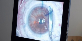 MACRO:激光眼科手术，第4步