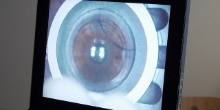 MACRO:激光眼科手术，第3步