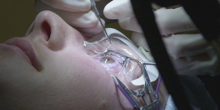 闭合:眼科医生移除lasik角膜瓣