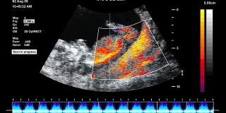 胎儿超声扫描