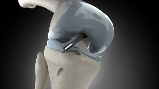 膝关节镜下十字韧带置换期视频素材模板下载