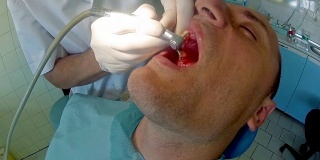 由于牙医的干预，病人的牙龈出血，关闭