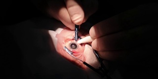 对人眼进行的外科手术