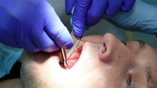 牙科植入手术视频素材模板下载