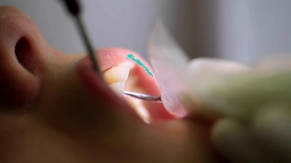 牙医。在牙科医生处作口腔检查时，应将病人张开的嘴巴封闭视频素材模板下载
