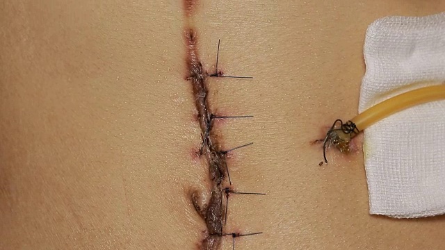 手术后留下的黑色纤维疤痕。在切除癌变痣的手术后缝合皮肤