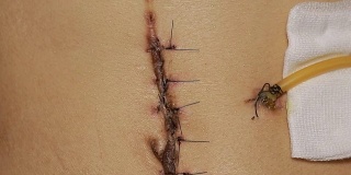 手术后留下的黑色纤维疤痕。在切除癌变痣的手术后缝合皮肤