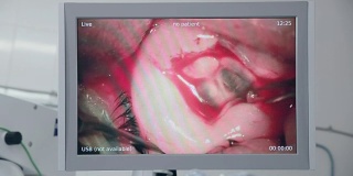 医生屏幕上的眼科手术。白内障摘除手术。近距离