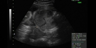 一个怀孕23周的漂亮宝宝的2D和3D超声波