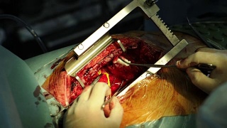 心脏的外科操作视频素材模板下载