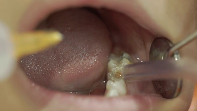 牙医将注射器轻轻注射到孩子的嘴里