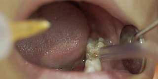 牙医将注射器轻轻注射到孩子的嘴里