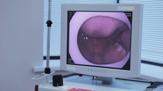 监控内窥镜，医生将他的相机胃镜通过病人的嘴贴在病人身上视频素材模板下载