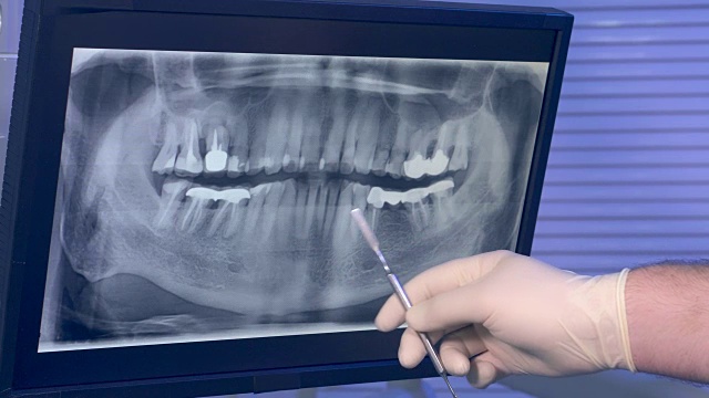 牙齿的x光全景照片和牙医的手与工具移动屏幕