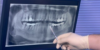 牙齿的x光全景照片和牙医的手与工具移动屏幕