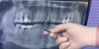 全景x光的牙齿在监视器和医生的手在手套与工具