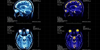 核磁共振脑部扫描未来显示四幅图片蓝色和蓝绿色在黑色的背景