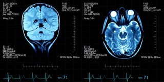 两个俯视图mri大脑扫描图像动画医学显示与心脏跳动和其他医疗数据