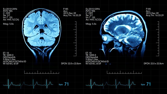两个动画图像的mri大脑扫描在一个医疗显示心脏bps和其他数据