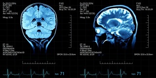 两个动画图像的mri大脑扫描在一个医疗显示心脏bps和其他数据