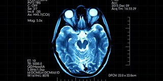 俯视图蓝绿色MRI脑部扫描显示动画数字和文字