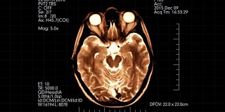 橙色俯视图脑mri扫描医学显示动画