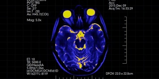 俯视图MRI大脑扫描与数据未来显示动画